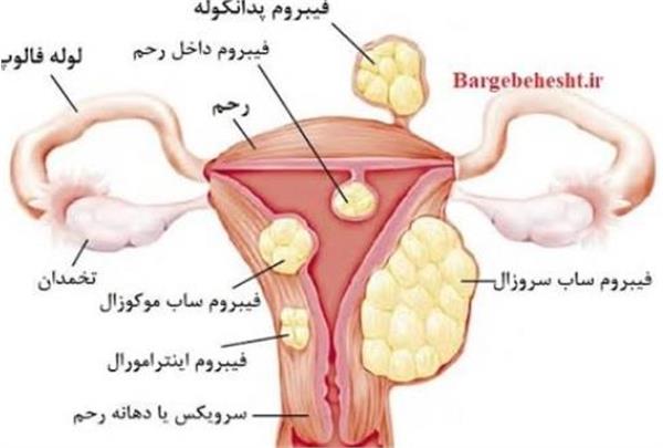 وبینار لیومیوم های رحمی از دیدگاه طب سنتی ایرانی و نوین مورخ 4 آبان ماه-مشاهده وبینار در لینک cmelearn.ir